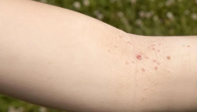 Lugege molluscum contagiosum'i kohta lastel, et mitte segi ajada teiste haigustega