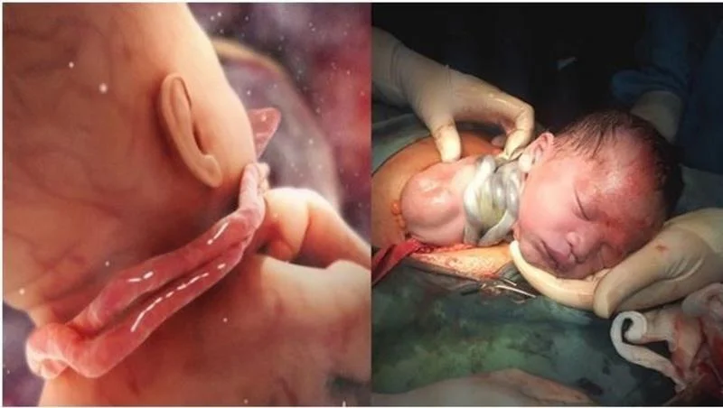 Hva er navlestrengen?  Hvorfor vikler navlestrengen seg rundt babyens hals?